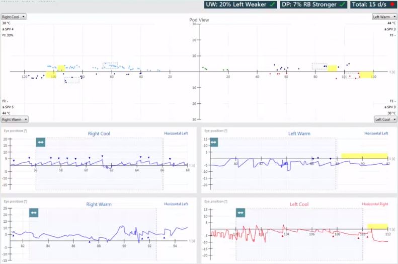 Aperçu des résultats avec vues de la position de la nacelle et de l'œil pour les irrigations froides à droite, chaudes à droite, chaudes à gauche et froides à gauche. Faiblesse unilatérale de 20 %, gauche plus faible. Prépondérance directionnelle de 7 %, nystagmus battant droit plus fort. Pour les irrigations droites froides, la vitesse moyenne de la phase lente est de 4 et l'indice de fixation est de 33 %. Pour les irrigations droites chaudes, la vitesse moyenne de la phase lente est de 5 sans indice de fixation calculé. Pour les irrigations gauches chaudes, la vitesse moyenne de la phase lente est de 3 sans indice de fixation calculé.