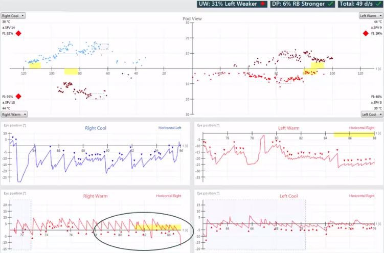 Aperçu des résultats avec vues de la position de la nacelle et de l’œil pour les irrigations froides à droite, chaudes à droite, chaudes à gauche et froides à gauche. Faiblesse unilatérale de 31 %, gauche plus faible. Prépondérance directionnelle de 6 %, nystagmus battant droit plus fort. Pour les irrigations droites froides, la vitesse moyenne de la phase lente est de 14 et l’indice de fixation est de 83 %. Pour les irrigations droites chaudes, la vitesse moyenne de la phase lente est de 18 et l’indice de fixation est de 95 %. Pour les irrigations gauches chaudes, la vitesse moyenne de la phase lente est de 9 et l’indice de fixation est de 59 %. Pour les irrigations gauches froides, la vitesse moyenne de la phase lente est de 8 et l’indice de fixation est de 40 %.