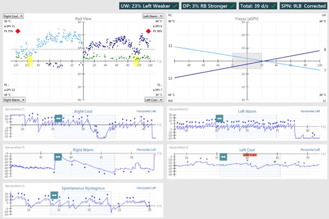 Aperçu des résultats avec vues de la position de la nacelle et de l’œil pour les irrigations froides à droite, chaudes à droite, chaudes à gauche et froides à gauche. Faiblesse unilatérale de 23 %, gauche plus faible. Prépondérance directionnelle de 3 %, nystagmus battant à droite plus fort. Pour les irrigations droites froides, la vitesse moyenne de la phase lente est de 11 et l’indice de fixation est de 75 %. Pour les irrigations droites chaudes, la vitesse moyenne de la phase lente est de 13 et l’indice de fixation n’est pas calculé. Pour les irrigations gauches chaudes, la vitesse moyenne de la phase lente est de 8 et l’indice de fixation est de 58 %. Pour les irrigations gauches froides, la vitesse moyenne de la phase lente est de 7 et l’indice de fixation n’est pas calculé.