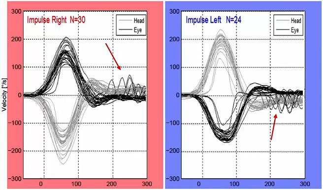 Graphiques de données de vitesse pour les impulsions droite-gauche montrant les courbes de la tête et des yeux avec les degrés en fonction des secondes. Les mouvements de la tête et des yeux correspondent bien dans les deux sens. Dans les deux sens, de 200 à 300 millisecondes, il y a des saccades de rattrapage à faible vitesse d'environ 50 degrés.