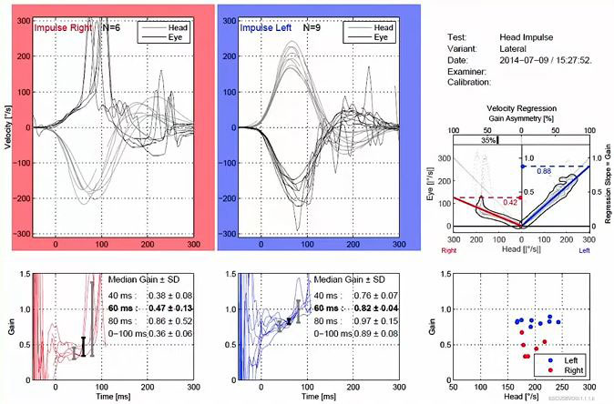 Graphiques de données de vitesse et de gain montrant les résultats du vHIT. Les graphiques de vitesse pour les impulsions droite-gauche montrent les courbes de la tête et des yeux avec des degrés en fonction des secondes. Les mouvements de la tête et des yeux correspondent mal dans la direction droite, mais correspondent dans la plage normale dans la direction gauche. Dans la direction droite, le gain médian à 60 millisecondes est de 0,47. Dans la direction gauche, le gain médian à 60 millisecondes est de 0,82.