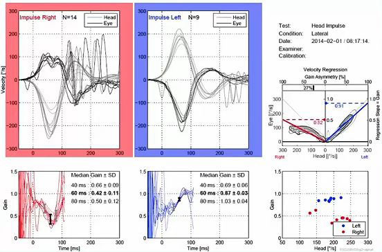Graphiques de données de vitesse et de gain montrant les résultats du vHIT. Les graphiques de vitesse pour les impulsions droite-gauche montrent les courbes de la tête et des yeux avec des degrés en fonction des secondes. Les mouvements de la tête et des yeux correspondent mal dans la direction droite, mais correspondent dans la plage normale dans la direction gauche. Dans la direction droite, le gain médian à 60 millisecondes est de 0,42. Dans la direction gauche, le gain médian à 60 millisecondes est de 0,87.