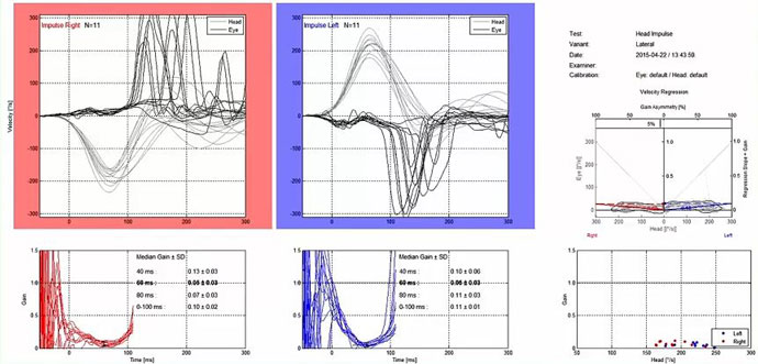 Graphiques de données de vitesse et de gain montrant les résultats du vHIT. Les graphiques de vitesse pour les impulsions droite-gauche montrent les courbes de la tête et des yeux avec des degrés en fonction des secondes. Les mouvements de la tête et des yeux correspondent mal dans les deux sens. Le gain médian à 60 millisecondes est de 0,05 dans les deux sens.