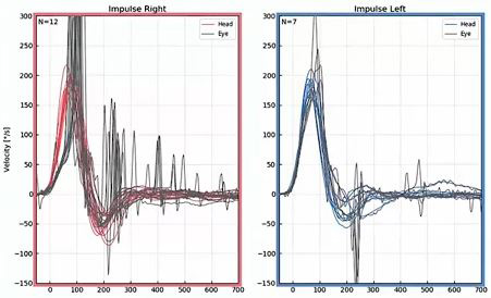 Les courbes de mouvement de la tête sont rouges pour les impulsions droites et bleues pour les impulsions gauches. Cela donne un meilleur contraste avec les courbes noires pour les mouvements des yeux. Avec les données superposées et la plage de données augmentée à 700 millisecondes, les pics de nystagmus spontané sont beaucoup plus visibles, à partir de 200 millisecondes et au-delà dans les deux sens.