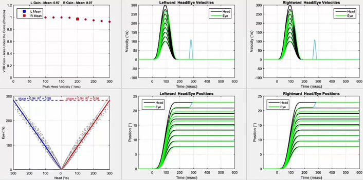 Six graphiques au total. Tout d'abord, un graphique avec le gain VOR en fonction de la vitesse de pointe de la tête en degrés par seconde. Pour les deux directions, le gain est de 1 jusqu'à ce qu'il diminue lentement à partir de 175 degrés par seconde. Pour toutes les vitesses, le gain est bien au-dessus de la coupure de 0,8. Deuxièmement, un graphique avec la vitesse de l'œil en degrés par seconde en fonction de la vitesse de la tête en degrés par seconde. Pour afficher les données pour les impulsions vers la gauche et vers la droite, l'axe des x est divisé en deux parties identiques, avec une vitesse de la tête de zéro degré par seconde au milieu, allant jusqu'à 300 degrés par seconde de chaque côté pour chaque direction d'impulsion de la tête. Ainsi, un gain VOR de 1 donnerait une ligne où la vitesse de la tête et de l'œil seraient toujours égales. Pour les deux directions, le nuage de points se rapproche de cette ligne, "Ensuite, nous avons les graphiques de vitesse et de position pour les impulsions vers la gauche. Dans le graphique de vitesse, les mouvements de la tête et des yeux sont représentés avec la vitesse, en degrés par seconde, en fonction du temps, en millisecondes. Pour la vitesse, les vitesses maximales des yeux correspondent bien aux vitesses maximales de la tête jusqu'à 250 degrés par seconde. Dans le graphique de position, les mouvements de la tête et des yeux sont représentés avec la position, en degrés, en fonction du temps, en millisecondes. Pour la position, les positions des yeux correspondent bien aux positions de la tête jusqu'à 15 degrés, après quoi elles commencent à chuter, avec une saccade manifeste nécessaire pour atteindre une impulsion où la tête a atteint 23 degrés. Cinquièmement et sixièmement, nous avons les graphiques de vitesse et de position pour les impulsions vers la droite. Ils présentent exactement les mêmes modèles de réponse que pour les impulsions vers la gauche.