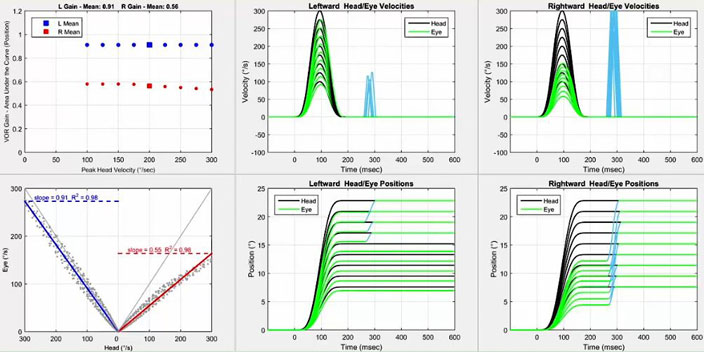Six graphiques au total. Tout d'abord, un graphique avec le gain VOR en fonction de la vitesse de pointe de la tête en degrés par seconde. Pour les impulsions gauches, le gain est inférieur à 1 mais supérieur au seuil de 0,8 pour toutes les vitesses de la tête. Pour les impulsions droites, le gain est compris entre 0,5 et 0,6 pour toutes les vitesses de la tête. Deuxièmement, un graphique avec la vitesse oculaire en degrés par seconde en fonction de la vitesse de la tête en degrés par seconde. Pour afficher les données pour les impulsions gauches et droites, l'axe des x est divisé en deux parties identiques, avec une vitesse de la tête de zéro degré par seconde au milieu, allant jusqu'à 300 degrés par seconde de chaque côté pour chaque direction d'impulsion de la tête. Ainsi, un gain VOR de 1 donnerait une ligne où la vitesse de la tête et de l'œil étaient toujours égales. Pour les impulsions gauches, la dispersion. Le graphique se situe assez près de cette ligne, légèrement en dessous des vitesses de tête les plus élevées, ce qui donne une pente de 0,91. Pour les impulsions droites, le nuage de points est bien en dessous de cette ligne, ce qui donne une pente de 0,55. Troisièmement et quatrièmement, nous avons les graphiques de vitesse et de position pour les impulsions vers la gauche. Dans le graphique de vitesse, les mouvements de la tête et des yeux sont représentés avec la vitesse, en degrés par seconde, en fonction du temps, en millisecondes. Pour la vitesse, les vitesses oculaires maximales correspondent bien aux vitesses de tête maximales jusqu'à 275 degrés par seconde. Dans le graphique de position, les mouvements de la tête et des yeux sont représentés avec la position, en degrés, en fonction du temps, en millisecondes. Pour la position, les positions des yeux sont immédiatement en retard par rapport aux positions de la tête, avec des saccades manifestes nécessaires pour correspondre aux positions de la tête à 17 degrés et plus. Cinquièmement et sixièmement, nous avons les graphiques de vitesse et de position pour les impulsions vers la droite. Pour la vitesse, les vitesses maximales des yeux ne correspondent bien aux vitesses maximales de la tête que jusqu'à 150 degrés par seconde. Les saccades manifestes à grande vitesse se produisent à 300 millisecondes. Pour la position, les saccades manifestes sont nécessaires pour correspondre à toutes les positions de la tête.