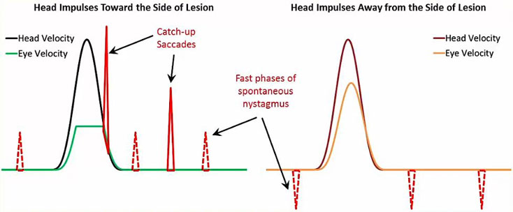 Tracés de vitesse des yeux et de la tête avec des phases rapides de nystagmus spontané se produisant avant et après les impulsions de la tête. Les vitesses du nystagmus spontané sont plus petites que les saccades de rattrapage, pointant dans la même direction pour les impulsions de la tête vers le côté de la lésion et pointant dans la direction opposée pour les impulsions de la tête loin du côté de la lésion.