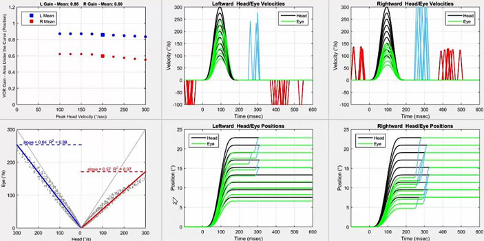 Six graphiques au total. Tout d'abord, un graphique avec le gain VOR en fonction de la vitesse maximale de la tête en degrés par seconde. Pour les impulsions gauches, le gain est inférieur à 1 mais supérieur au seuil de 0,8 pour toutes les vitesses de la tête. Pour les impulsions droites, le gain oscille autour de 0,6 pour toutes les vitesses de la tête. Deuxièmement, un graphique avec la vitesse oculaire en degrés par seconde en fonction de la vitesse de la tête en degrés par seconde. Pour afficher les données pour les impulsions gauches et droites, l'axe des x est divisé en deux parties identiques, avec une vitesse de la tête de zéro degré par seconde au milieu, allant jusqu'à 300 degrés par seconde de chaque côté pour chaque direction d'impulsion de la tête. Ainsi, un gain VOR de 1 donnerait une ligne où la vitesse de la tête et de l'œil étaient toujours égales. Pour les impulsions gauches, le nuage de points se situe légèrement en dessous de cette ligne, ce qui donne une pente de 0,84. Pour les impulsions droites, le nuage de points est bien en dessous de cette ligne, ce qui donne une pente de 0,57. Troisièmement et quatrièmement, nous avons les graphiques de vitesse et de position pour les impulsions gauches. Dans le graphique de vitesse, les mouvements de la tête et des yeux sont tracés avec la vitesse, en degrés par seconde, en fonction du temps, en millisecondes. Pour la vitesse, les vitesses oculaires maximales correspondent bien aux vitesses oculaires maximales jusqu'à 250 degrés par seconde. Des saccades manifestes assez importantes se produisent entre 250 et 300 millisecondes. Des phases rapides de nystagmus spontané dans la direction opposée sont visibles avant et après l'impulsion de la tête. Dans le graphique de position, les mouvements de la tête et des yeux sont tracés avec la position, en degrés, en fonction du temps, en millisecondes. Pour la position, les positions des yeux sont immédiatement en retard par rapport aux positions de la tête, les saccades manifestes devant correspondre aux positions de la tête à 15 degrés et plus. Cinquièmement et sixièmement, nous avons les graphiques de vitesse et de position pour les impulsions vers la droite. Pour la vitesse, les vitesses maximales des yeux ne correspondent bien aux vitesses maximales de la tête que jusqu'à 150 degrés par seconde. Les saccades manifestes à grande vitesse se produisent à 300 millisecondes. Des phases rapides de nystagmus spontané dans la même direction sont visibles avant et après l'impulsion de la tête. Pour la position, les saccades manifestes sont nécessaires pour correspondre à toutes les positions de la tête.