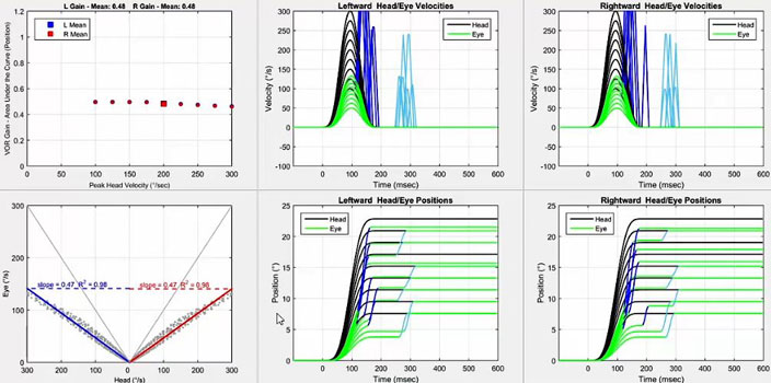Six graphiques au total. Tout d'abord, un graphique avec le gain VOR en fonction de la vitesse de pointe de la tête en degrés par seconde. Pour les deux directions, le gain oscille juste en dessous de 0,5 pour toutes les vitesses de la tête. Deuxièmement, un graphique avec la vitesse oculaire en degrés par seconde en fonction de la vitesse de la tête en degrés par seconde. Pour afficher les données pour les impulsions vers la gauche et vers la droite, l'axe des x est divisé en deux parties identiques, avec une vitesse de la tête de zéro degré par seconde au milieu, allant jusqu'à 300 degrés par seconde de chaque côté pour chaque direction d'impulsion de la tête. Ainsi, un gain VOR de 1 donnerait une ligne où la vitesse de la tête et de l'œil seraient toujours égales. Pour les deux directions, les nuages de points oscillent bien en dessous de cette ligne, donnant des pentes de 0,47. Les quatre graphiques restants sont les graphiques de vitesse et de position pour les impulsions vers la gauche et vers la droite. Impulsions vers la droite. Dans le graphique de vitesse, les mouvements de la tête et des yeux sont représentés avec la vitesse, en degrés par seconde, en fonction du temps, en millisecondes. Pour les deux directions, les vitesses oculaires maximales ne correspondent bien aux vitesses de pointe de la tête que jusqu'à 125 degrés par seconde. Pour les deux directions, des saccades manifestes assez importantes se produisent entre 250 et 300 millisecondes. Pour les deux directions, des saccades cachées se produisent vers la fin de l'impulsion de la tête. Dans le graphique de position, les mouvements de la tête et des yeux sont représentés avec la position, en degrés, en fonction du temps, en millisecondes. Pour les deux directions, un mélange de saccades manifestes et cachées est effectué pour toutes les positions de la tête.