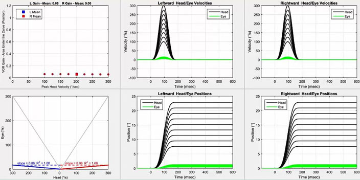 Six graphiques au total. Tout d'abord, un graphique avec le gain VOR en fonction de la vitesse de pointe de la tête en degrés par seconde. Pour les deux directions, le gain oscille en dessous de 0,1 pour toutes les vitesses de la tête. Deuxièmement, un graphique avec la vitesse de l'œil en degrés par seconde en fonction de la vitesse de la tête en degrés par seconde. Pour afficher les données pour les impulsions vers la gauche et vers la droite, l'axe des x est divisé en deux parties identiques, avec une vitesse de la tête de zéro degré par seconde au milieu, allant jusqu'à 300 degrés par seconde de chaque côté pour chaque direction d'impulsion de la tête. Ainsi, un gain VOR de 1 donnerait une ligne où la vitesse de la tête et de l'œil seraient toujours égales. Pour les deux directions, les nuages de points oscillent bien en dessous de cette ligne, donnant des pentes de 0,06. Les quatre graphiques restants sont la vitesse et la position graphiques pour les impulsions vers la gauche et vers la droite. Dans le graphique de vitesse, les mouvements de la tête et des yeux sont représentés avec la vitesse, en degrés par seconde, en fonction du temps, en millisecondes. Pour les deux directions, les vitesses maximales des yeux sont loin d'être proches des vitesses maximales de la tête. Dans le graphique de position, les mouvements de la tête et des yeux sont représentés avec la position, en degrés, en fonction du temps, en millisecondes. Pour les deux directions, les positions des yeux sont loin d'être proches des positions de la tête.