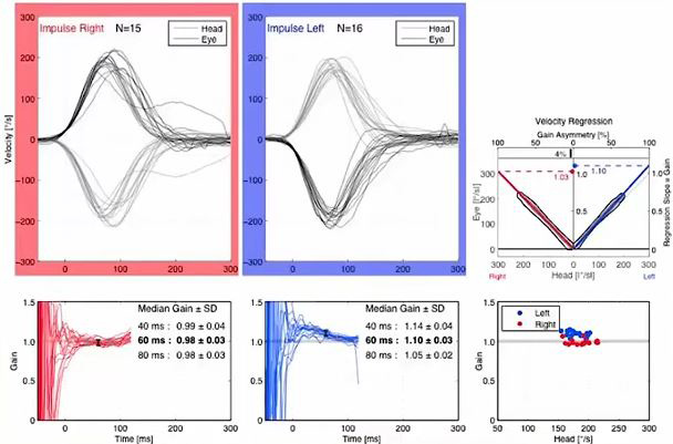 Graphiques de données de vitesse et de gain montrant les résultats vHIT. Les graphiques de vitesse pour les impulsions droite-gauche montrent les courbes de la tête et des yeux avec des degrés en fonction des secondes. Les mouvements de la tête et des yeux correspondent bien dans les deux sens, avec une vitesse de pointe d'environ 200 degrés juste avant 100 millisecondes. Dans la direction droite, le gain médian à 60 millisecondes est de 0,98. Dans la direction gauche, le gain médian à 60 millisecondes est de 1,10.