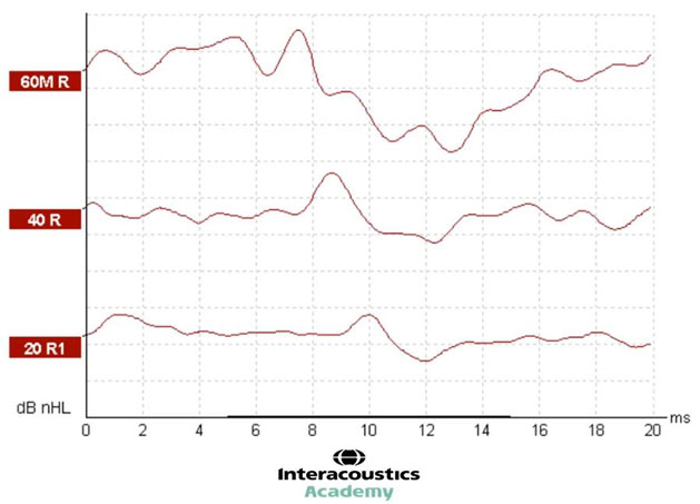 Graphique avec dB nHL en fonction des millisecondes. Les trois formes d’onde ont des ondes V clairement identifiables.