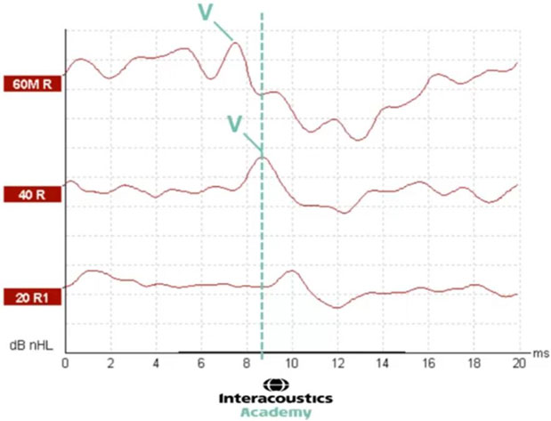 Graphique avec dB nHL en fonction des millisecondes. Une ligne pointillée verticale à 8,5 millisecondes montre la latence de l'onde V pour le niveau d'intensité nHL de 40 dB.