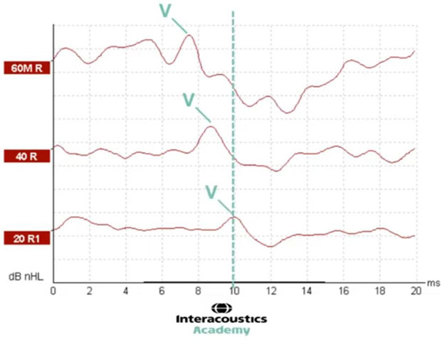 Graphique avec dB nHL en fonction des millisecondes. Une ligne pointillée verticale à 10 millisecondes montre la latence de l'onde V pour le niveau d'intensité nHL de 20 dB.