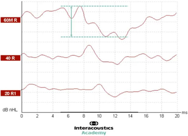 Graphique avec dB nHL en fonction des millisecondes. Deux lignes horizontales en pointillés montrent le pic de l’onde V et le creux suivant. Une flèche entre ces deux lignes pointillées indique la distance, qui est l'amplitude. L'amplitude est d'environ 15 dB nHL.