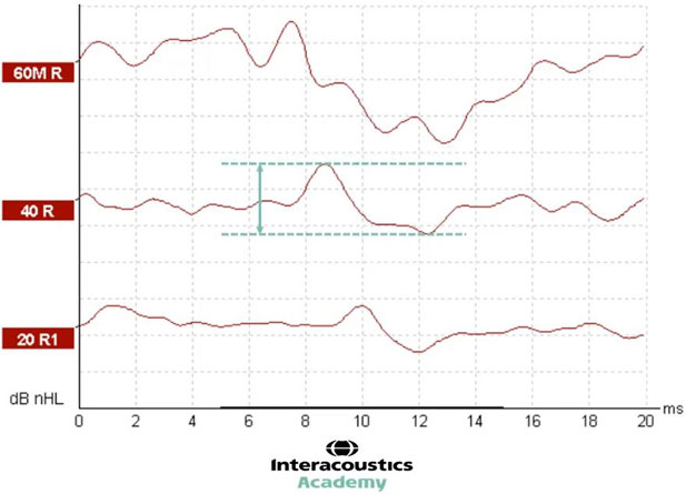 Graphique avec dB nHL en fonction des millisecondes. Deux lignes horizontales en pointillés montrent le pic de l’onde V et le creux suivant. Une flèche entre ces deux lignes pointillées indique la distance, qui est l'amplitude. L'amplitude est d'environ 10 dB nHL.