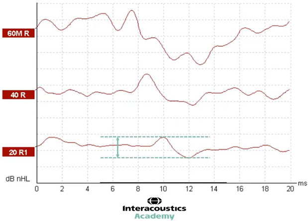 Graphique avec dB nHL en fonction des millisecondes. Deux lignes pointillées horizontales montrent le pic de l’onde V et le creux suivant. Une flèche entre ces deux lignes pointillées indique la distance, qui est l'amplitude. L'amplitude est d'environ 8 dB nHL.