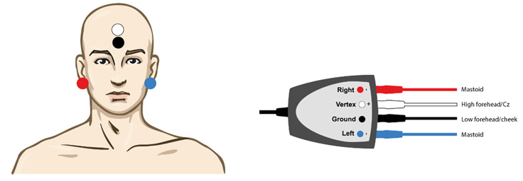 Right electrode on right ear. Left electrode on left ear. Vertex electrode on high forehead. Ground electrode on low forehead.