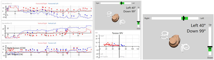 3D image of a head, with semicircular canals displayed for both ears. The x-axis ranges from right to left, and the y-axis ranges from down to up. A green shaded area on both axes displays where to point the head, and a black marker indicates whether the patient's head is pointed correctly. Both black markers are in the green region, and the 3D head is pointing accordingly. In this instance, to the left and down.