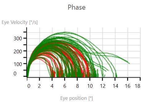 Evenly distributed phase, with both eyes reaching an eye position between 4 to 12 degrees predominantly.